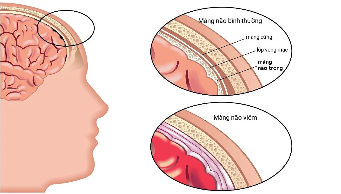 Hình ảnh về viêm màng não mô cầu